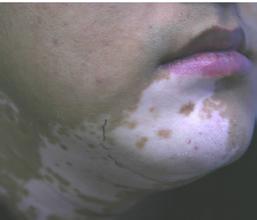 白癜风怎么辛苦治疗才能康复.jpg
