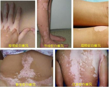 造成儿童患白癜风的主要原因是什么.jpg